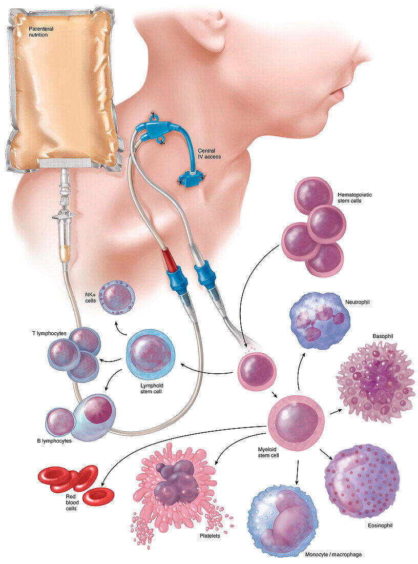 Haematopoietic stem cell transplantation, illustration