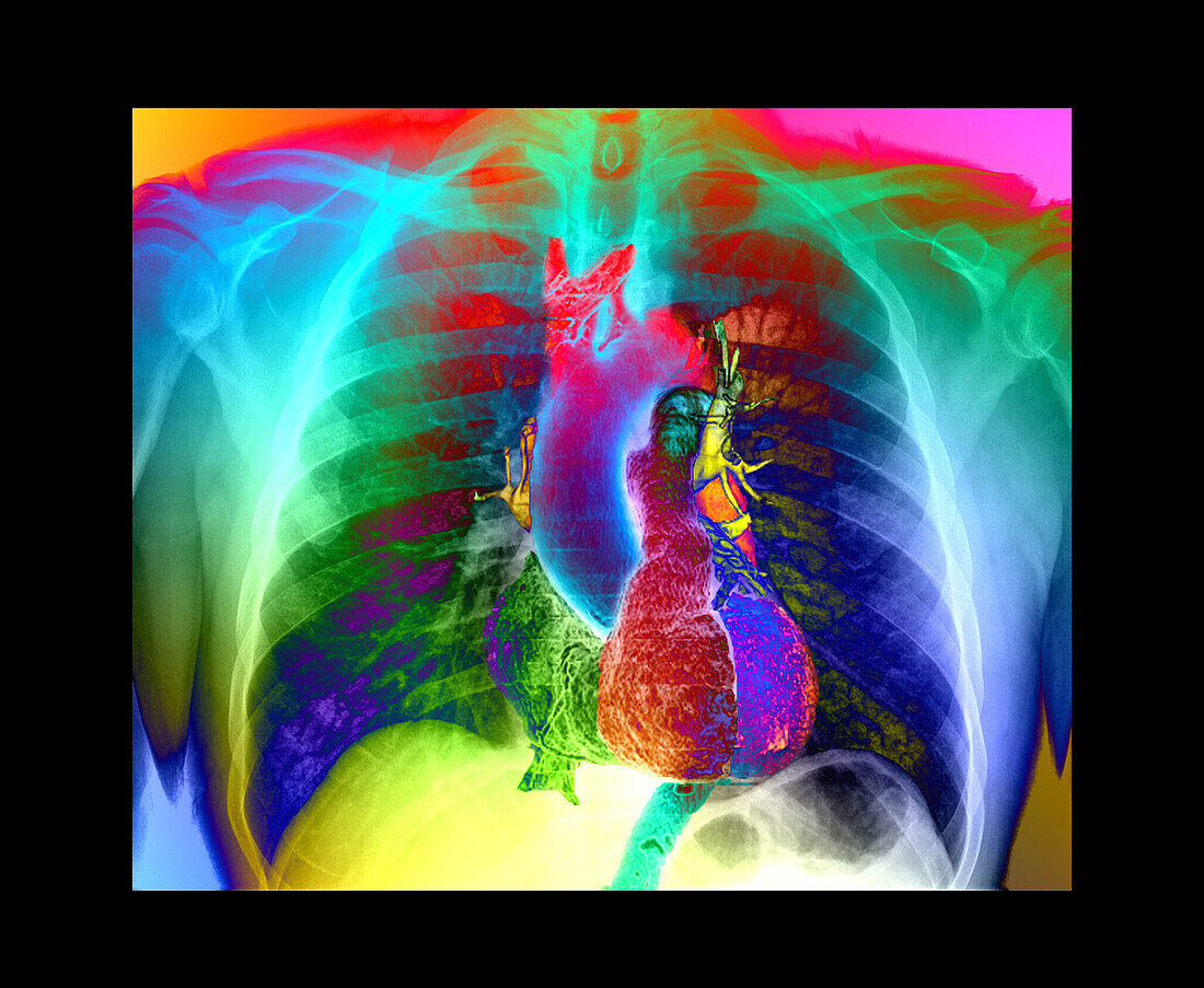 Chest and heart, CT scan and X-ray