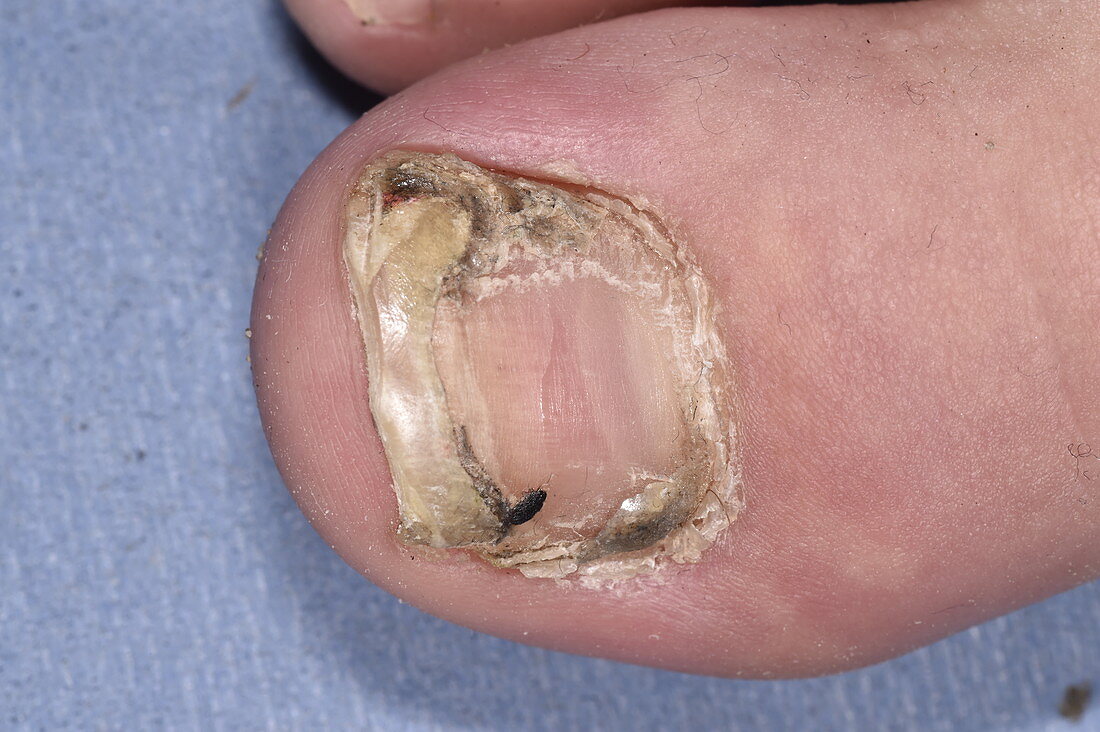 Pseudomonas bacterial nail infection