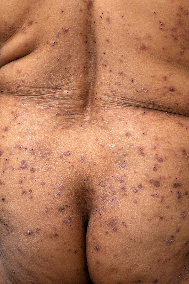 Dermatitis herpetiformis