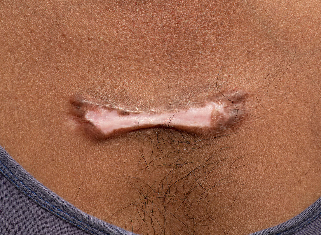 Keloid scar