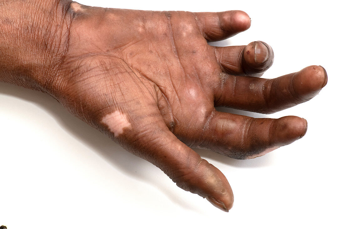 Hand affected by leprosy