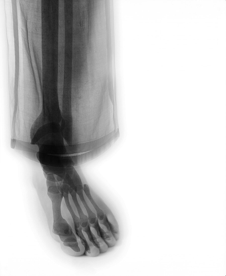 Lower leg in trousers, X-ray