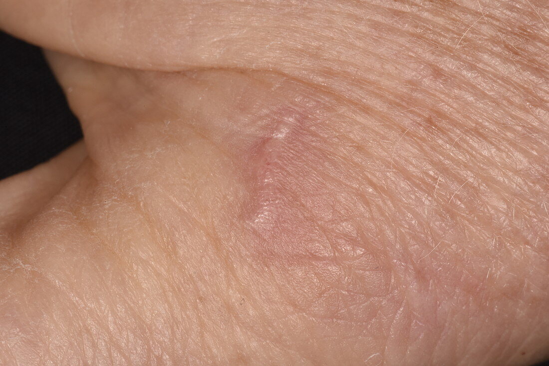 Scabies burrow in the skin