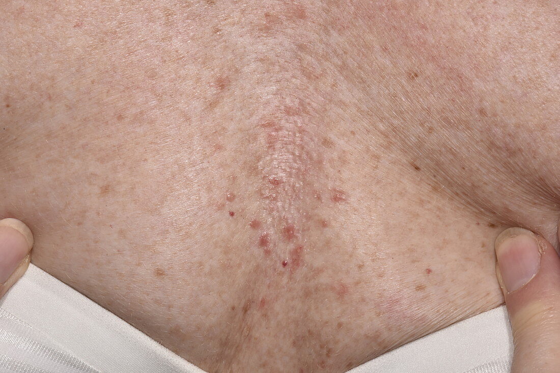 Folliculitis of the chest