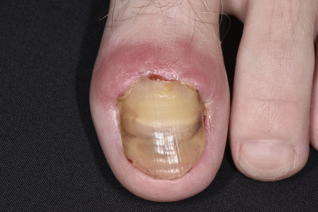 Infected toenail