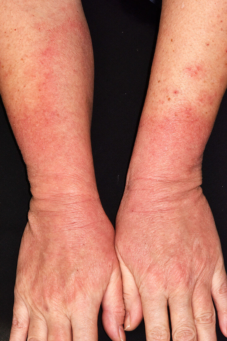 Atopic dermatitis