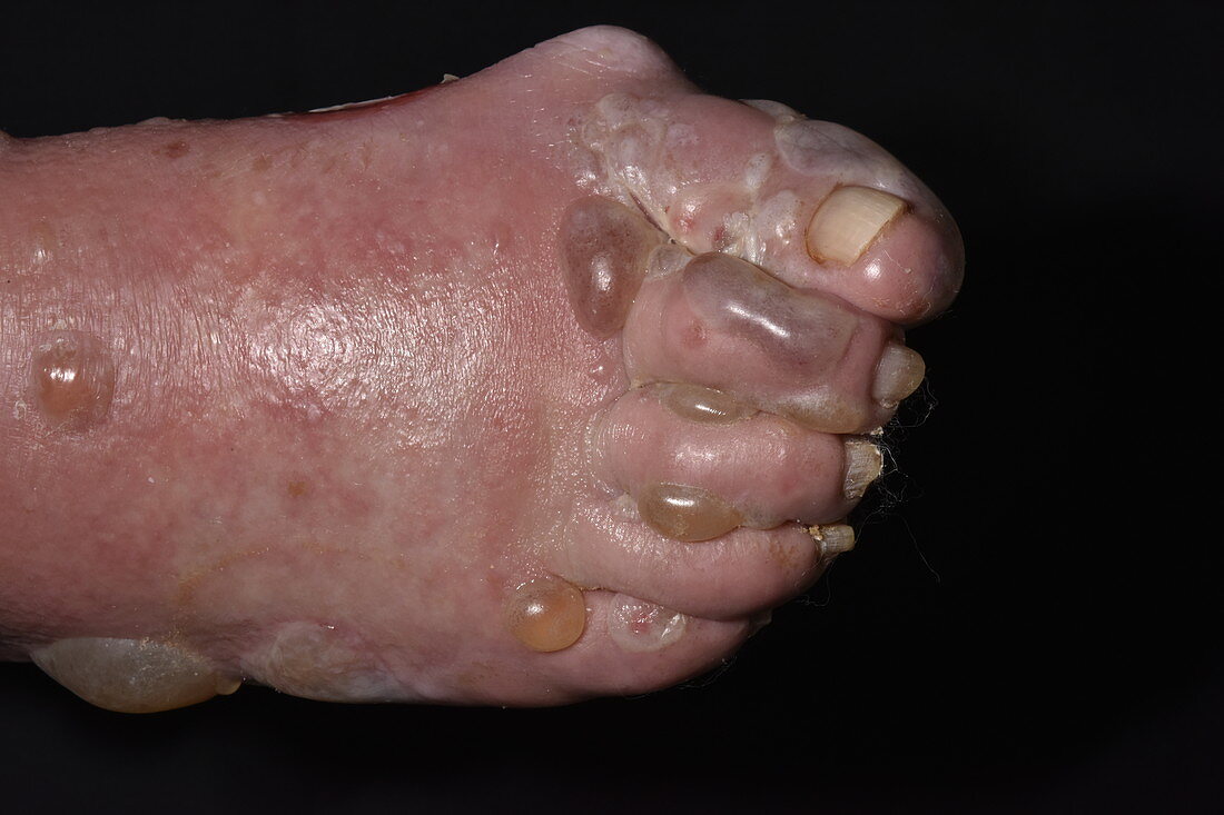 Bullous pemphigoid blisters