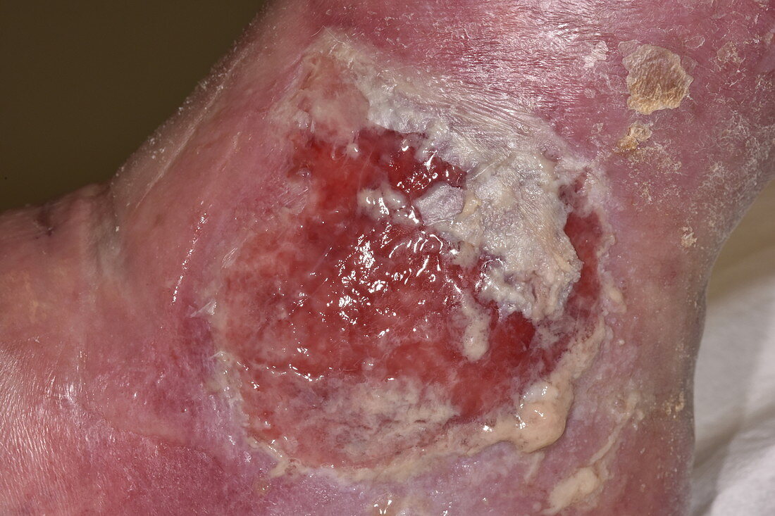 Ulcer