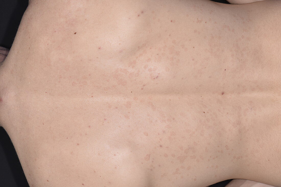 Pityriasis rosea rash