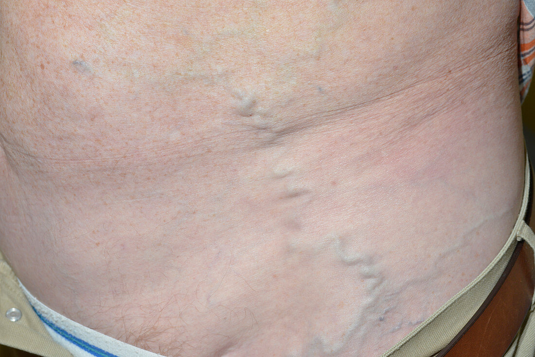 Prominent abdominal vein in retroperitoneal fibrosis