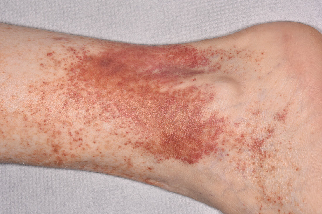 Post inflammatory skin pigmentation