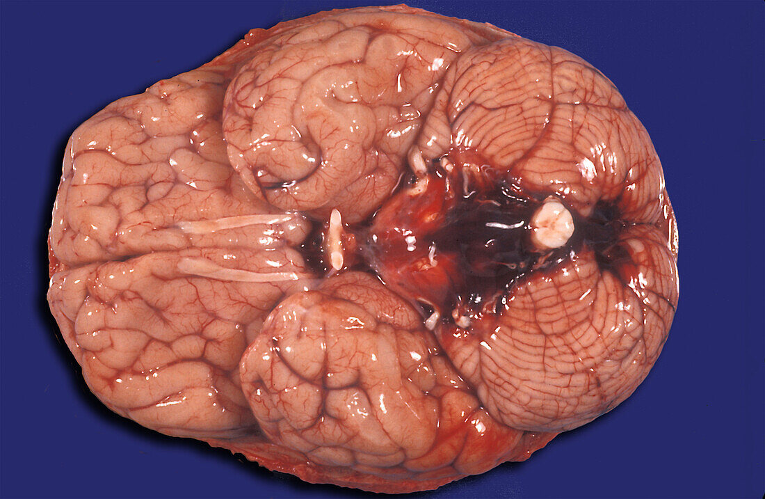 Human brain. Subarachnoid hemorrage