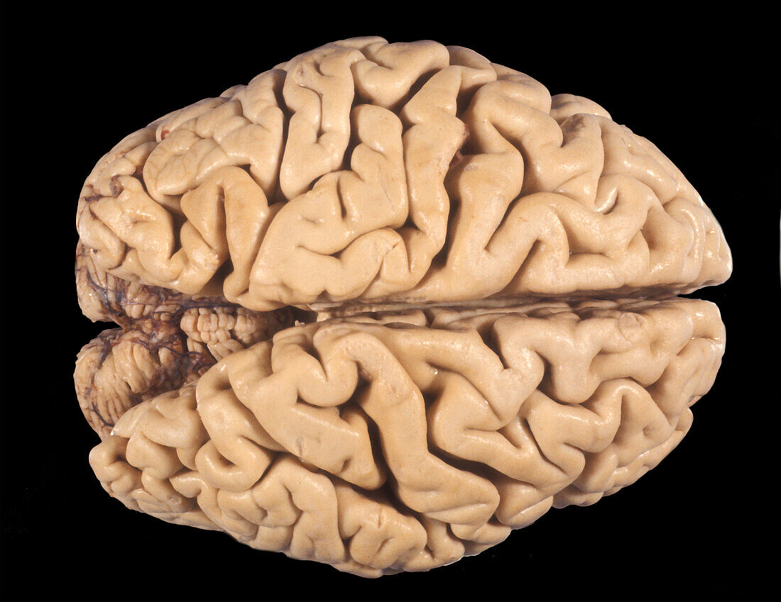 Human Brain, Atrophy of Cerebral Cortex