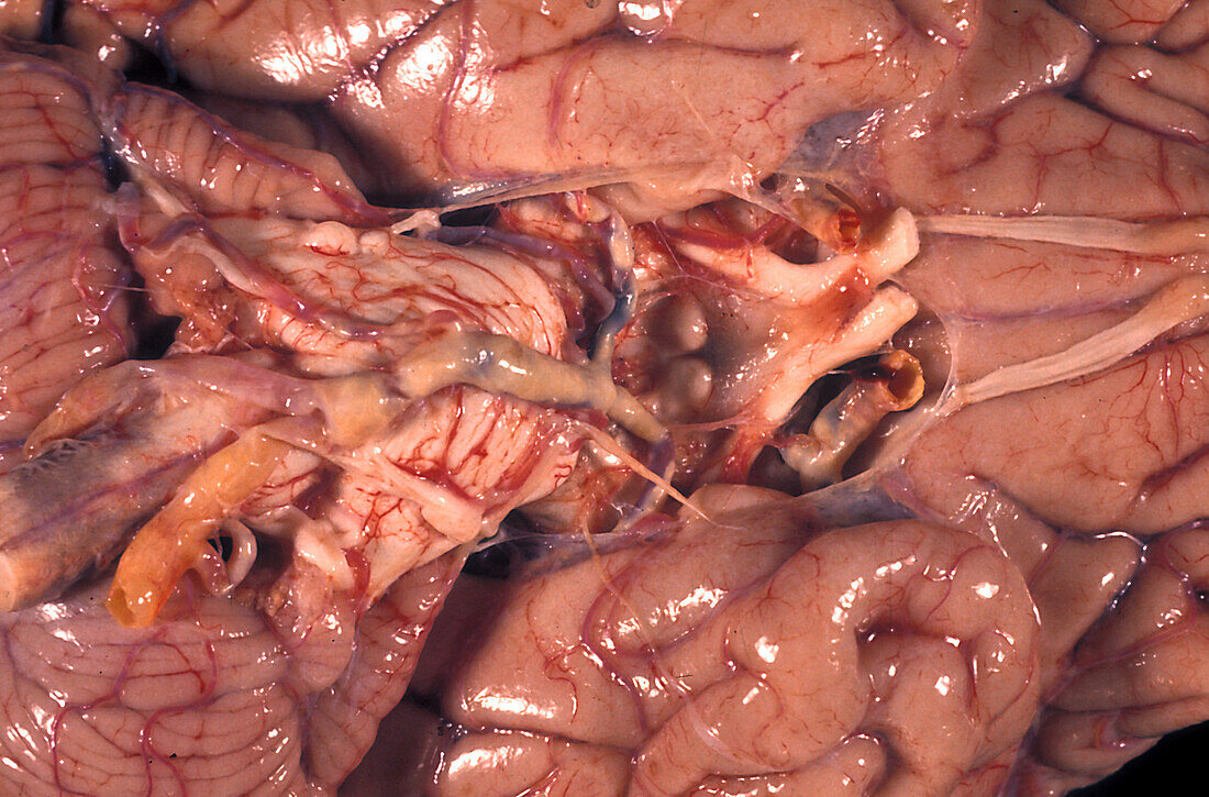 Human Brain, Plaques in the Circle of Willis