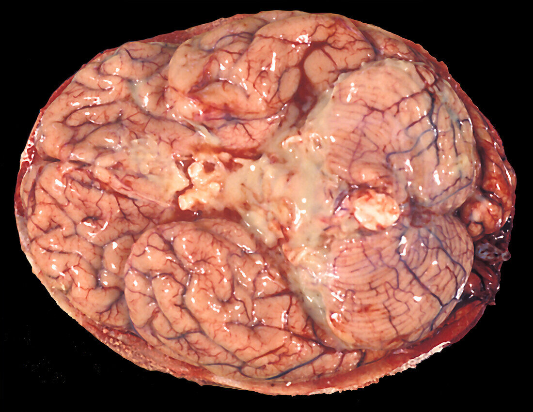 Human Brain, Meningitis