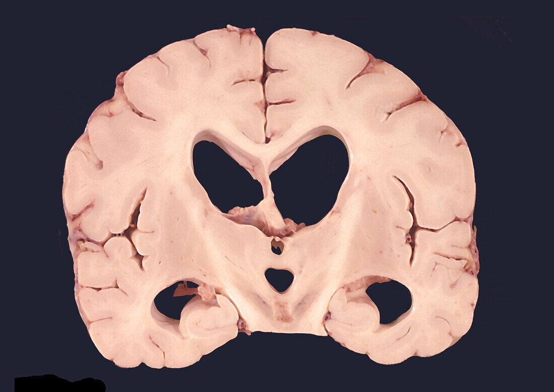 Human Brain, Hydrocephalus