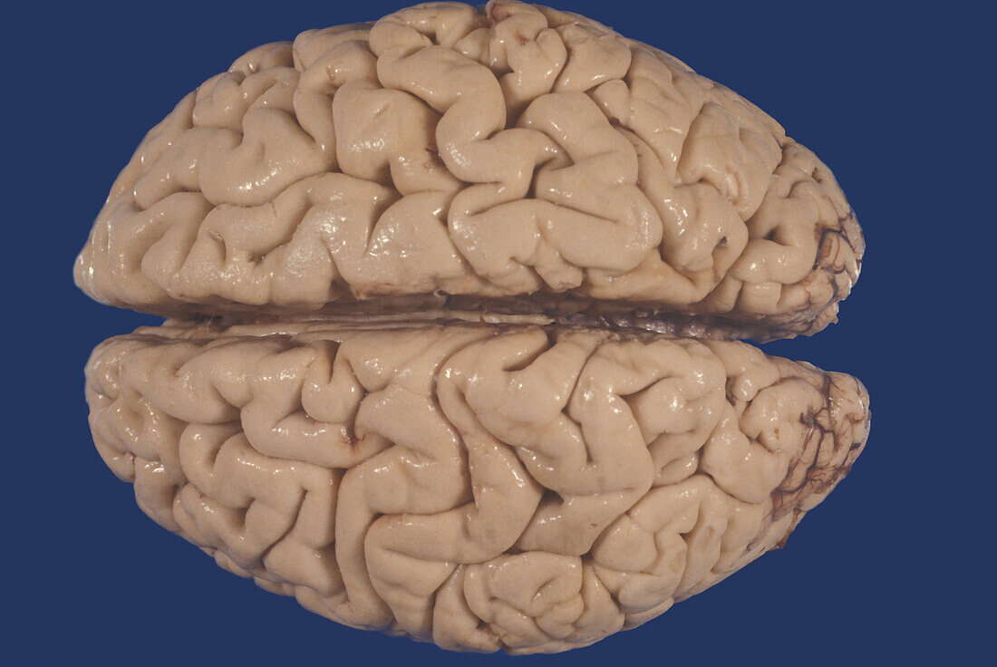Human Brain, Cortical Atrophy