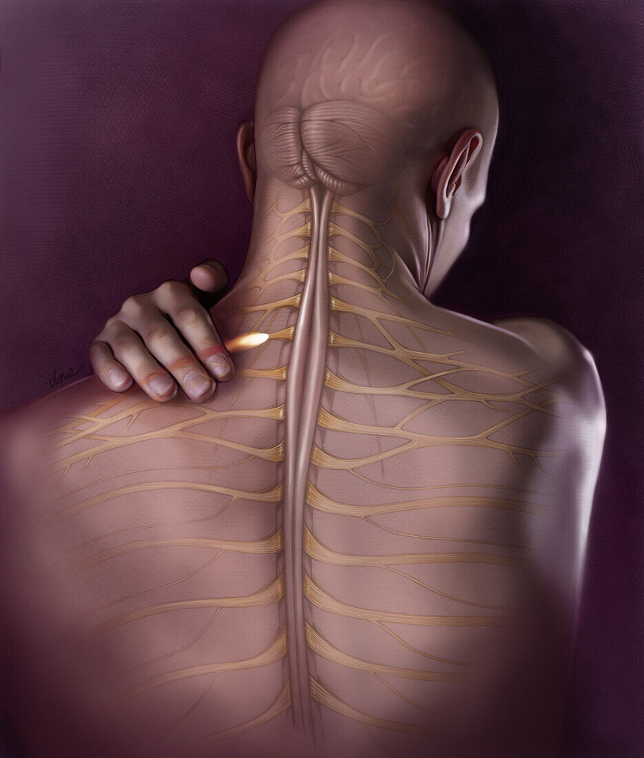 Back Pain, Illustration