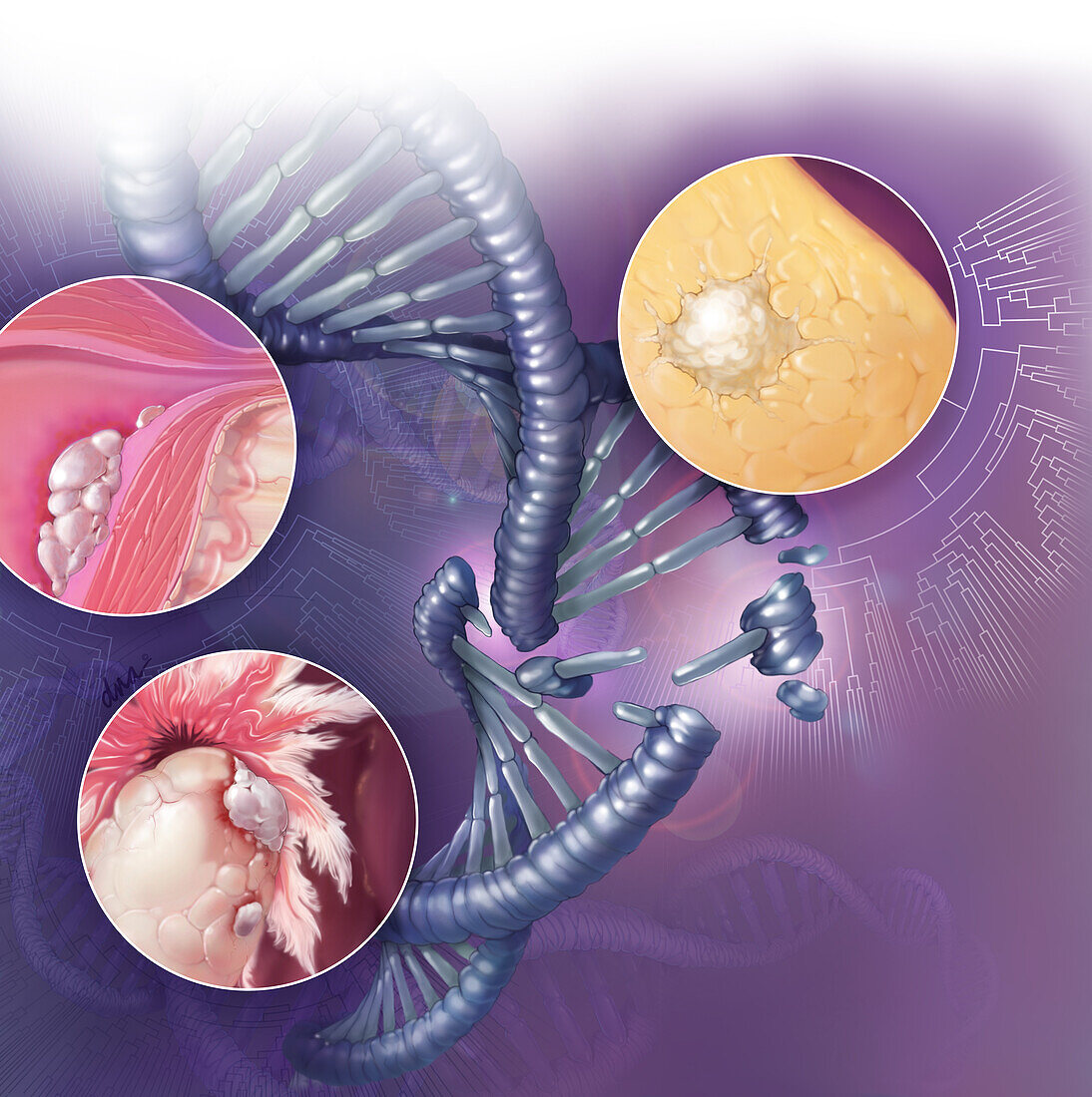 Inhereted Gynelogical Cancers Illustration