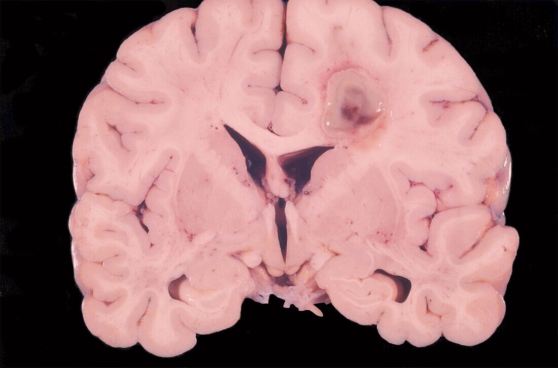 Human Brain Cyst