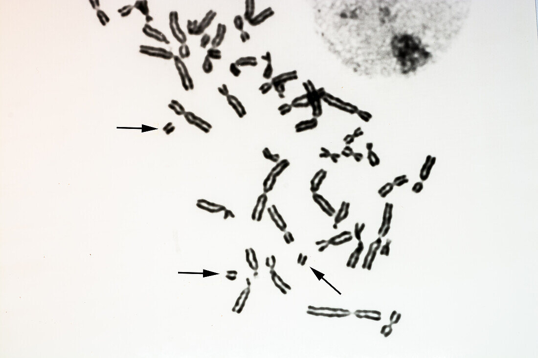 Human Chromosome Aberrations