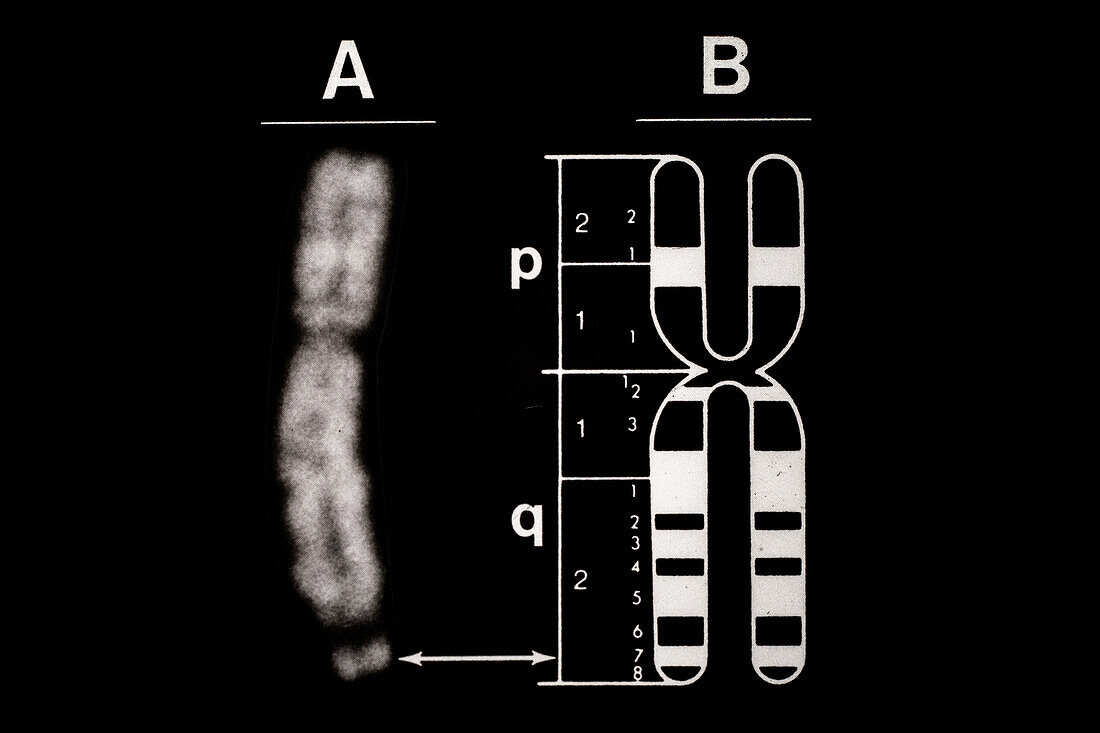 Fragile-X Chromosome with Idiogram