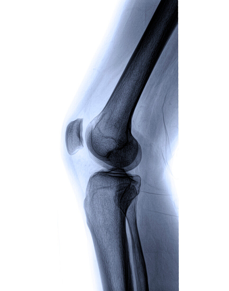 X-Ray of a knee