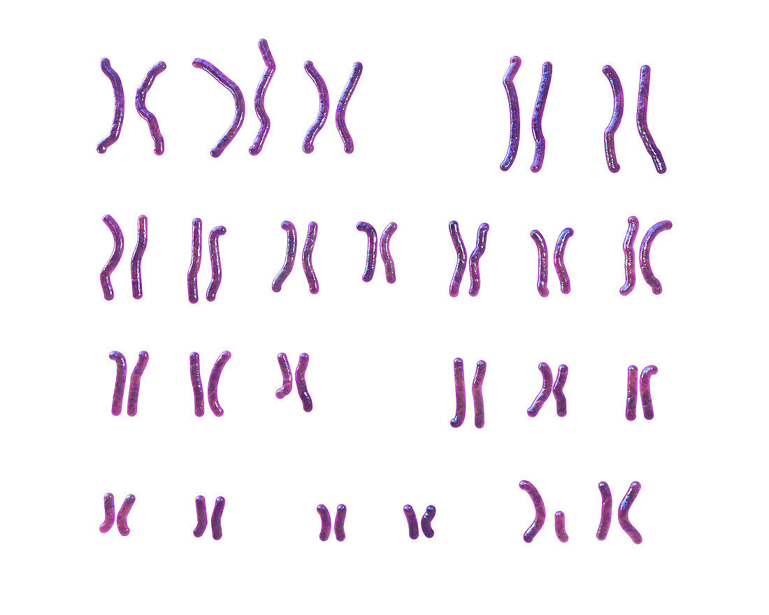 Karyotype of Angelman syndrome, illustration