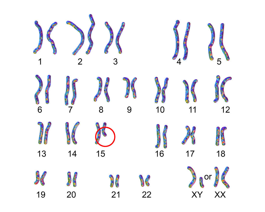 Karyotype of Prader-Willi syndrome, illustration