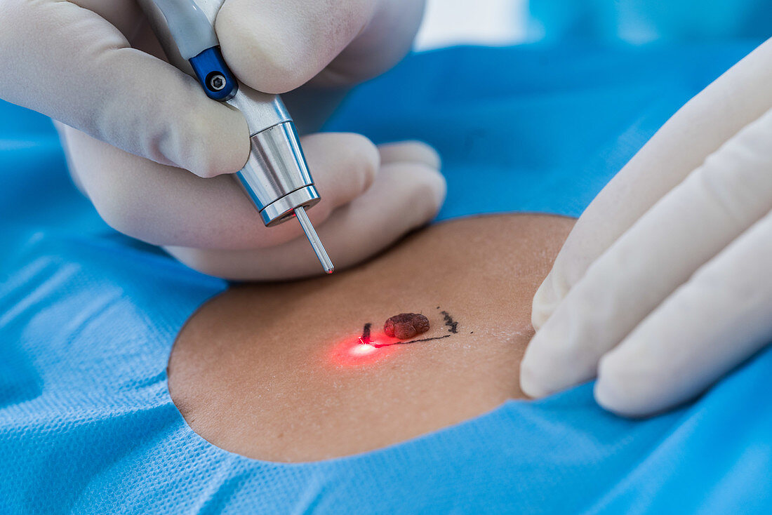 Excision of a nevus (mole) using a CO2 surgical laser