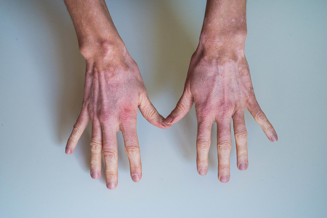 Vitiligo, skin pigment loss