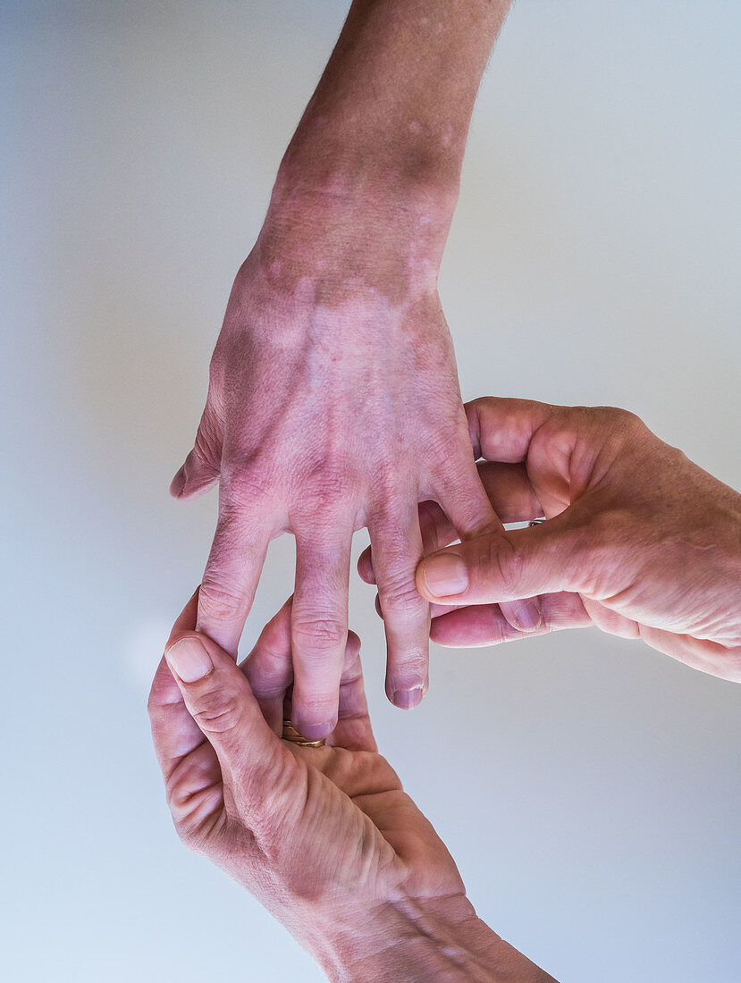 Vitiligo, skin pigment loss