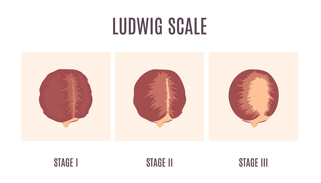 Ludwig scale of baldness in women,