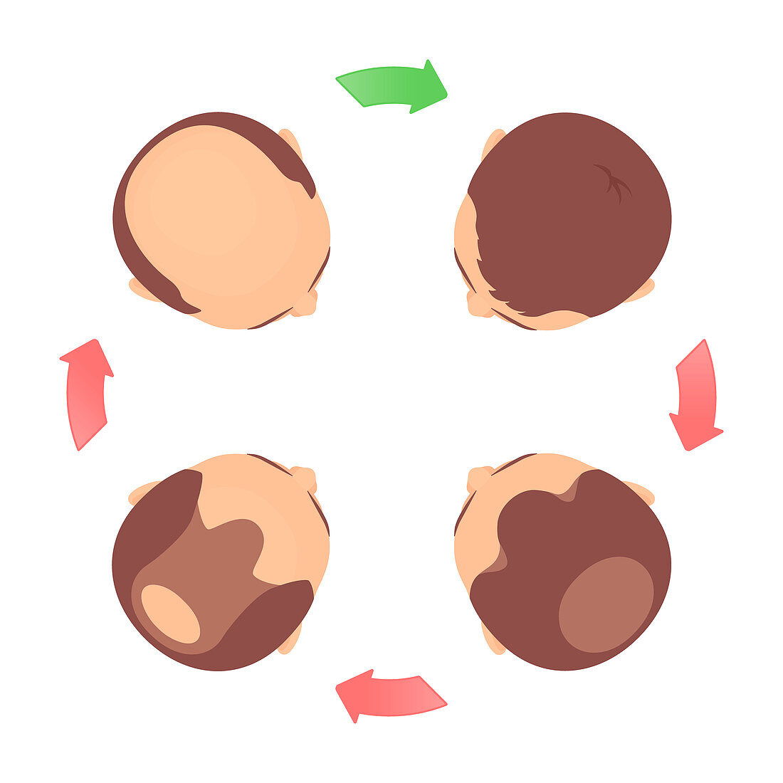 Hair loss stages in men, illustration