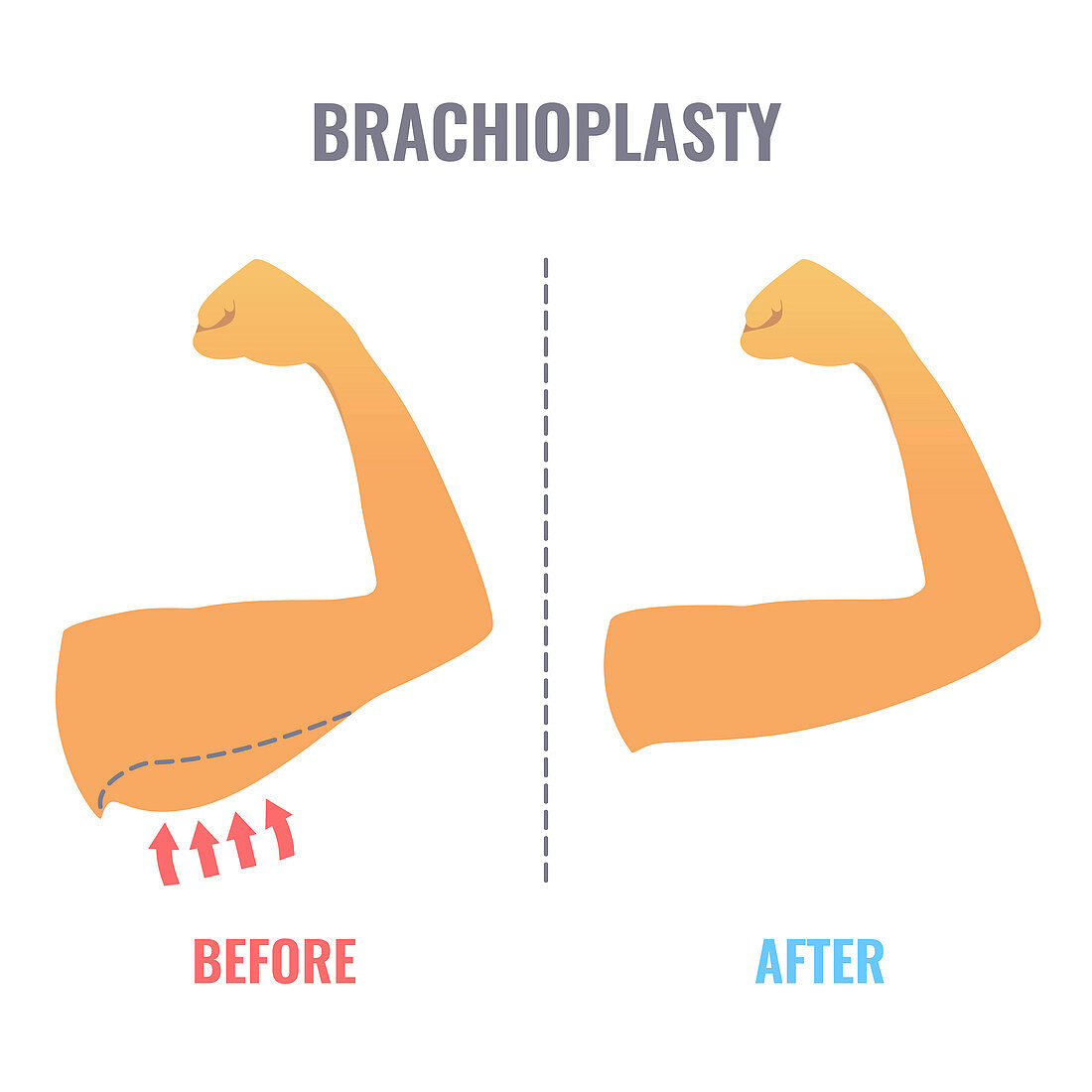 Brachioplasty, illustration