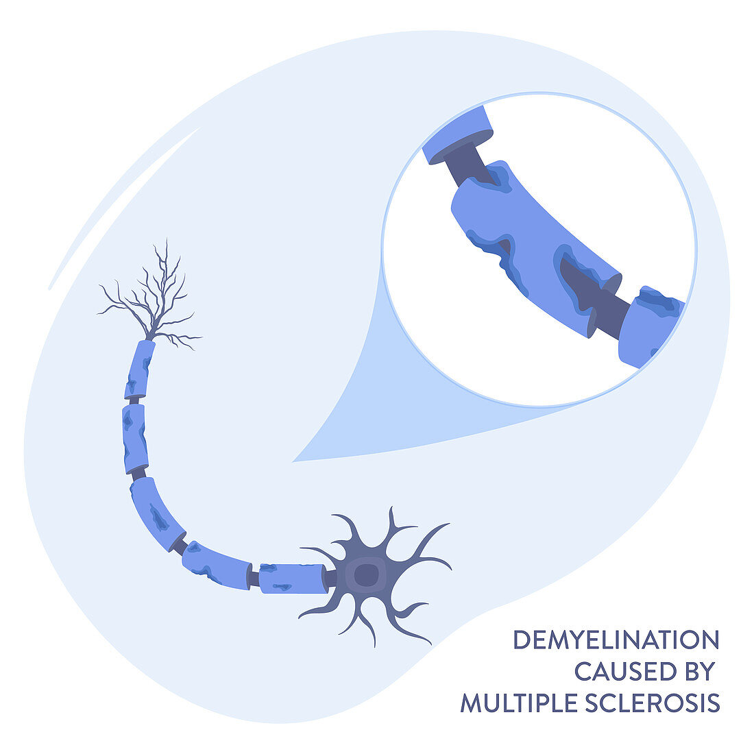Multiple sclerosis, illustration