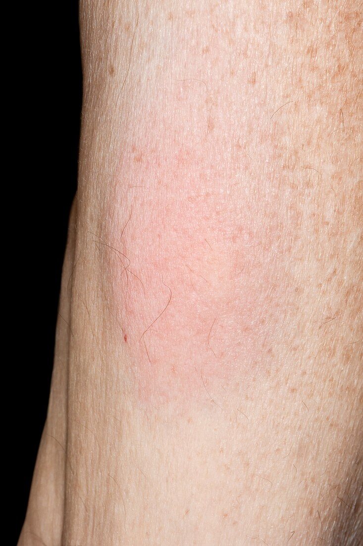 Allergic reaction to tick bite