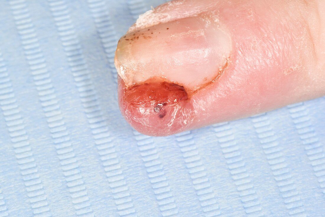 Granulation tissue over fingernail