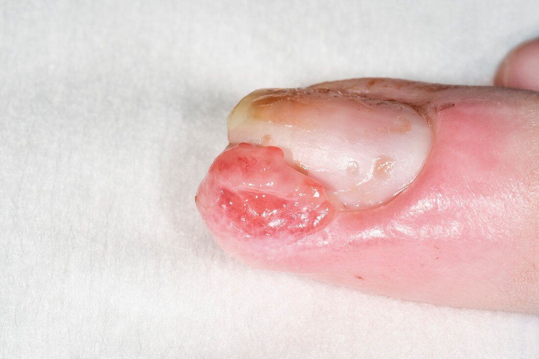 Granulation tissue over fingernail