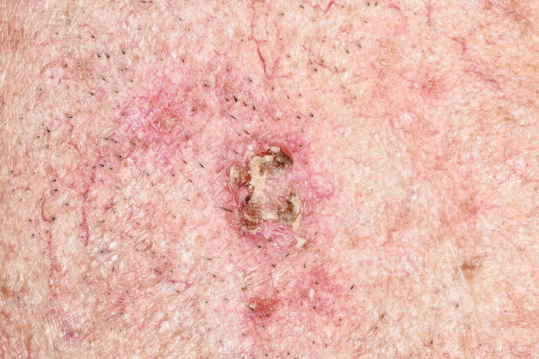 Basal cell carcinoma