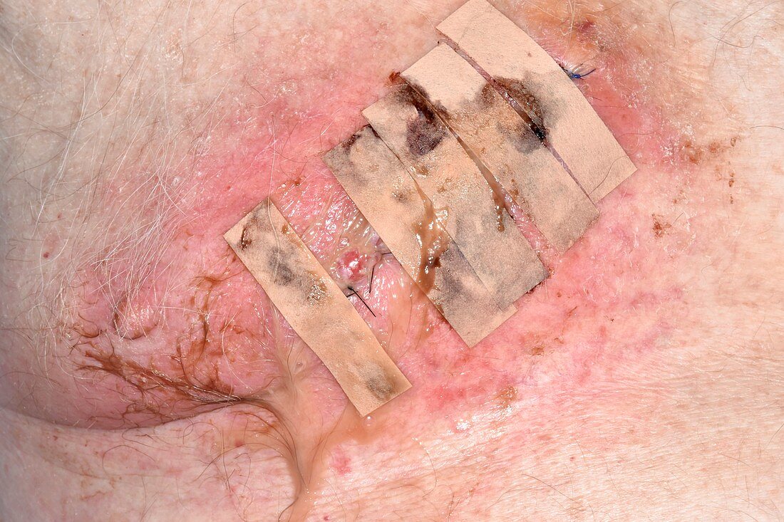 Infected wound