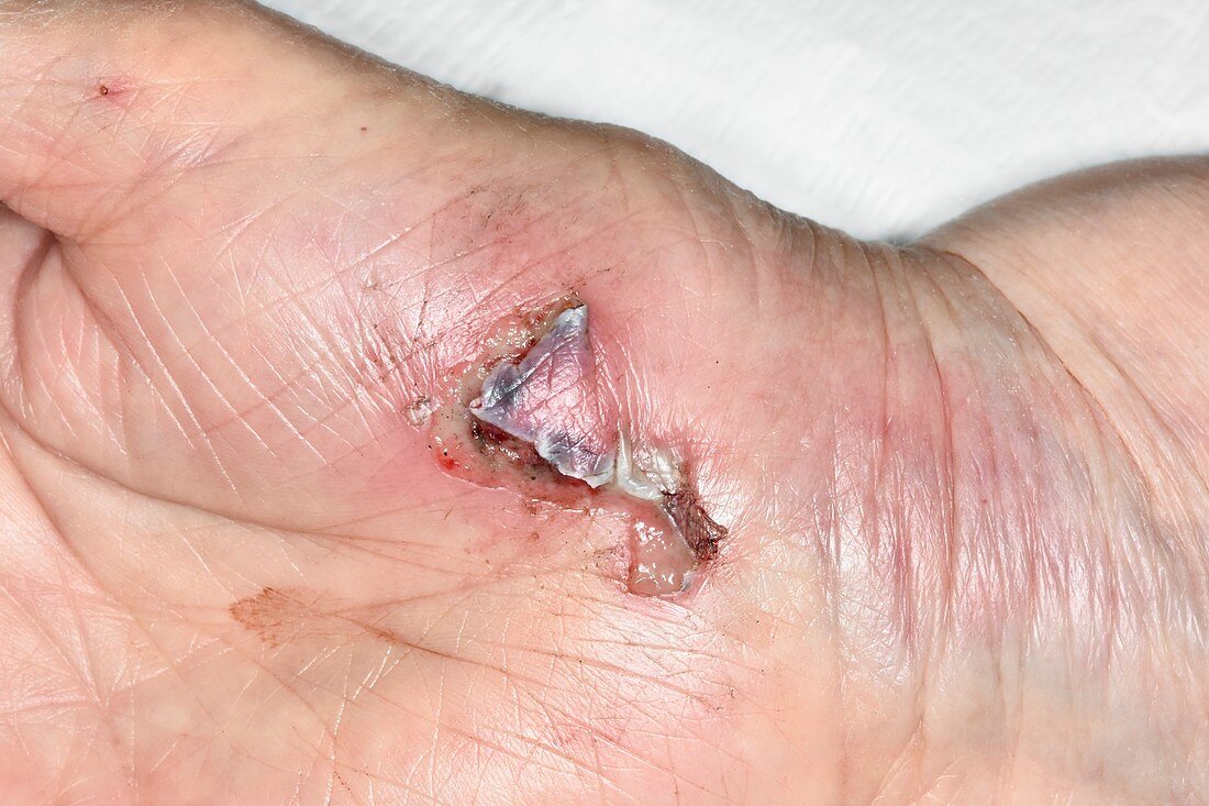 Laceration on palm