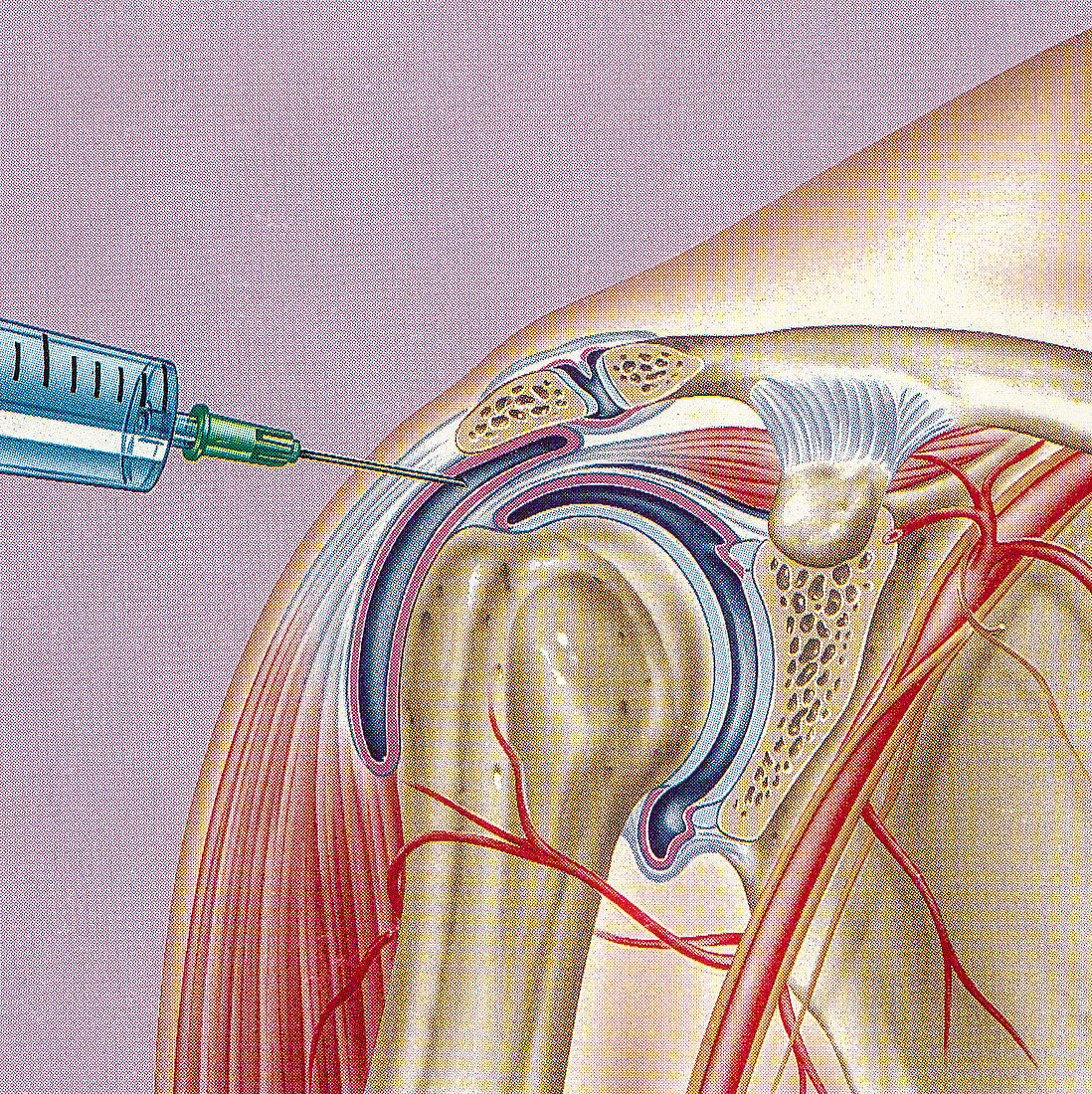 Steroid treatment of shoulder joint, illustration