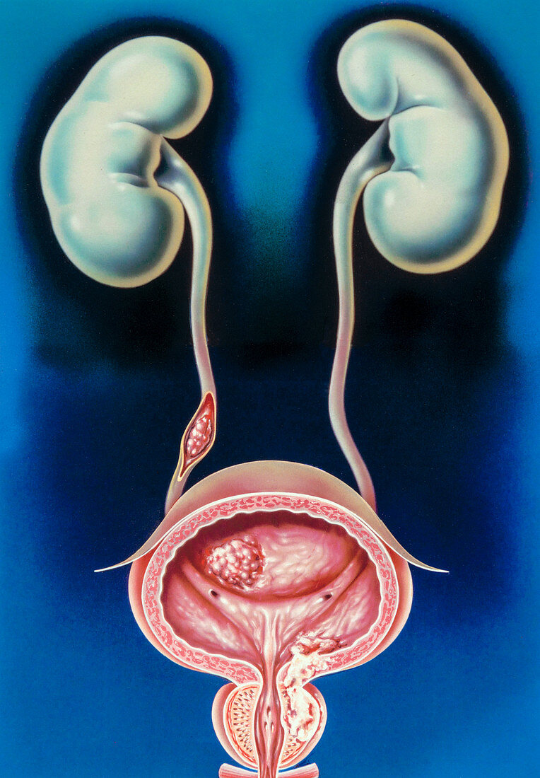 Male urogenital cancers, illustration