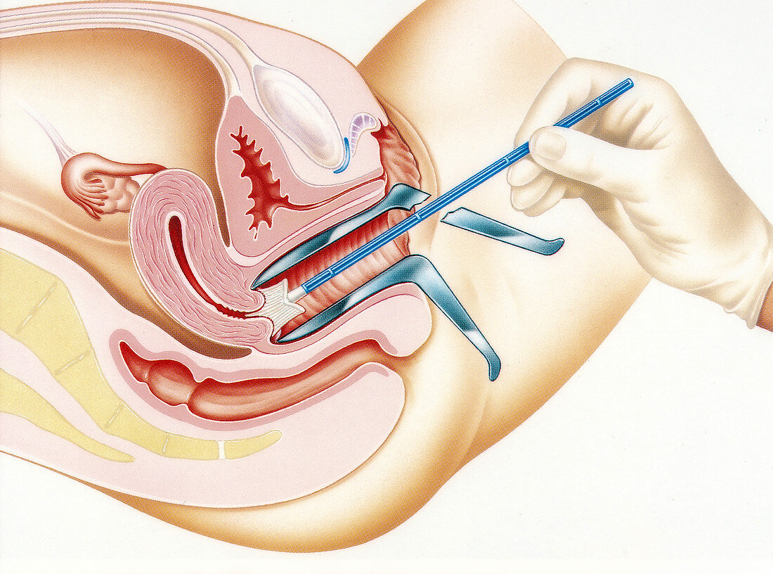 Cervical smear test, illustration