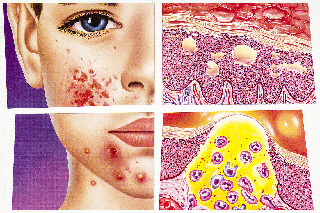 Eczema and acne, illustration