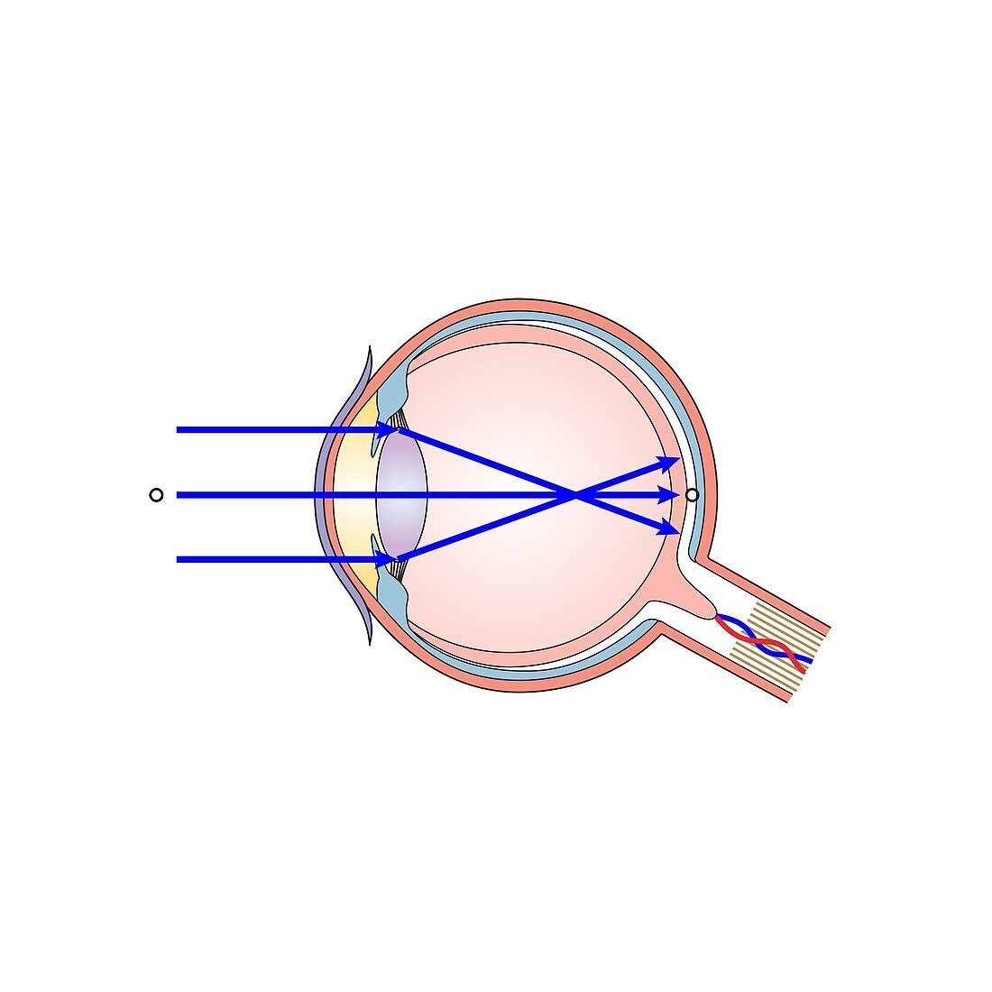 Short-sightedness, illustration