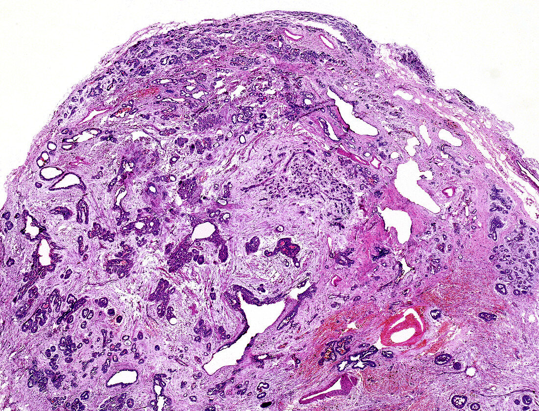 Fibrocystic disease of the breast, light micrograph