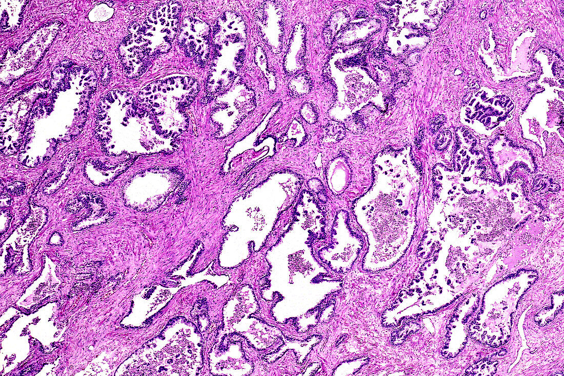 Prostate cancer, light micrograph